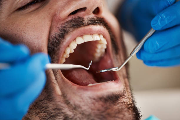 Dental Bonding in Sunrise Beach Village, TX